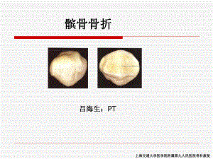 髌骨骨折康复ppt课件.pps