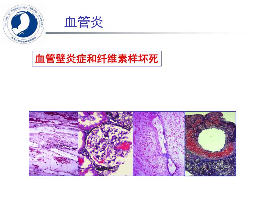 ANCA相关小血管炎的研究和治疗进展.ppt_第2页