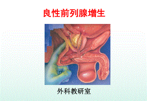 《良性前列腺增生》PPT课件.ppt