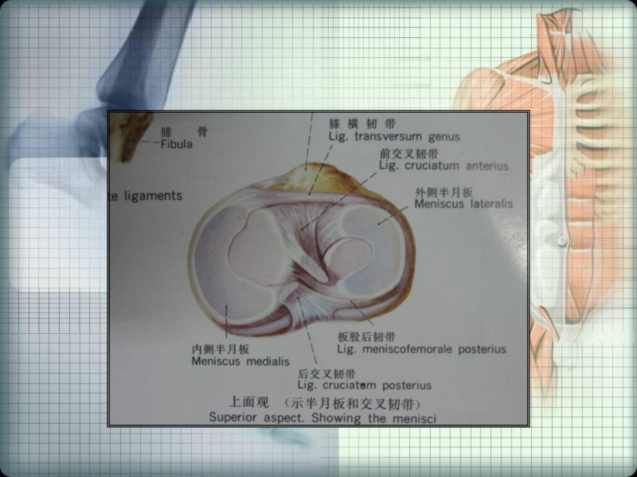 最新半月板损伤的磁共振表现幻灯片.ppt_第2页