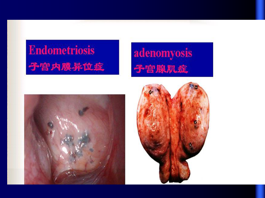 《子宫脱垂内膜异位》PPT课件.ppt_第2页