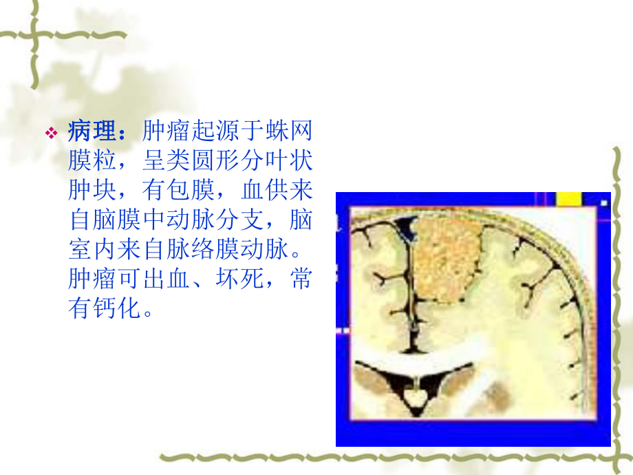 脑膜瘤CT诊断ppt课件.ppt_第2页