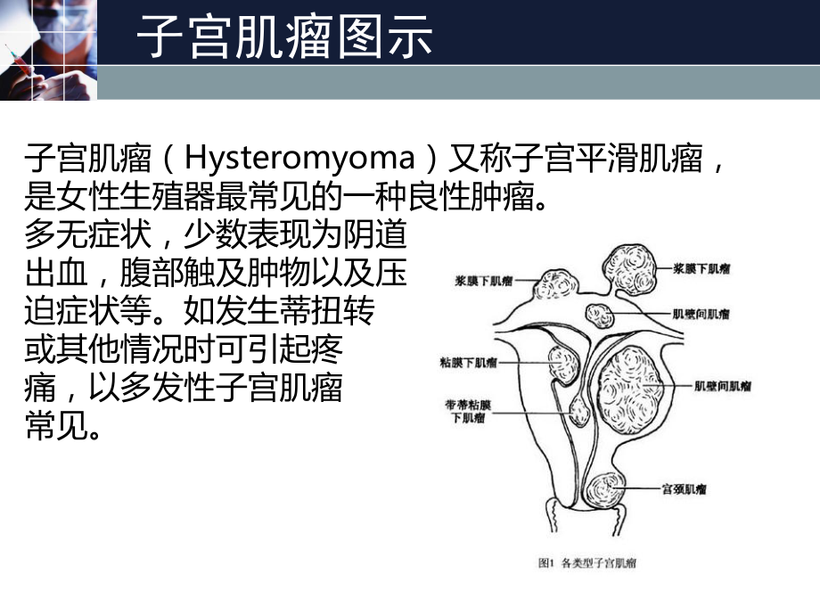 子宫肌瘤的自查方法.ppt_第2页