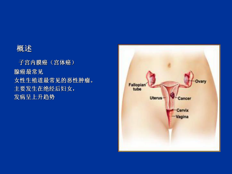 子宫内膜癌 2013.ppt_第2页