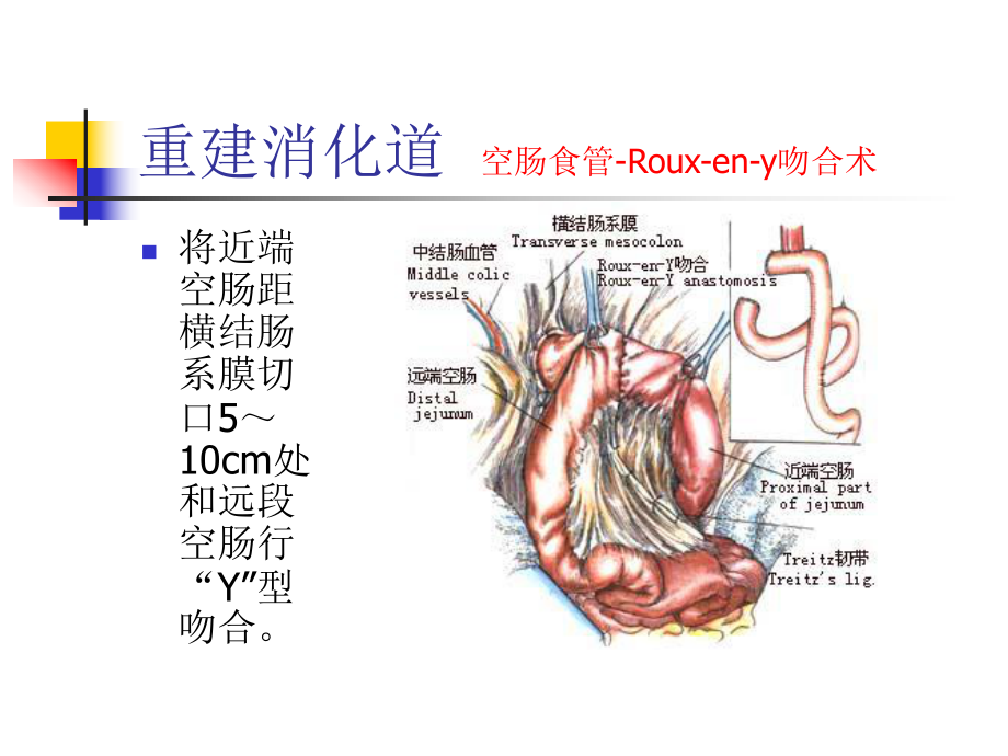 图解全胃切除术三ppt课件.ppt_第2页