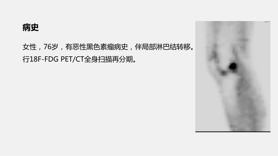 PET之膝关节骨性关节炎影像学病例ppt课件.pptx_第2页