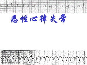 恶性心律失常ppt课件.ppt