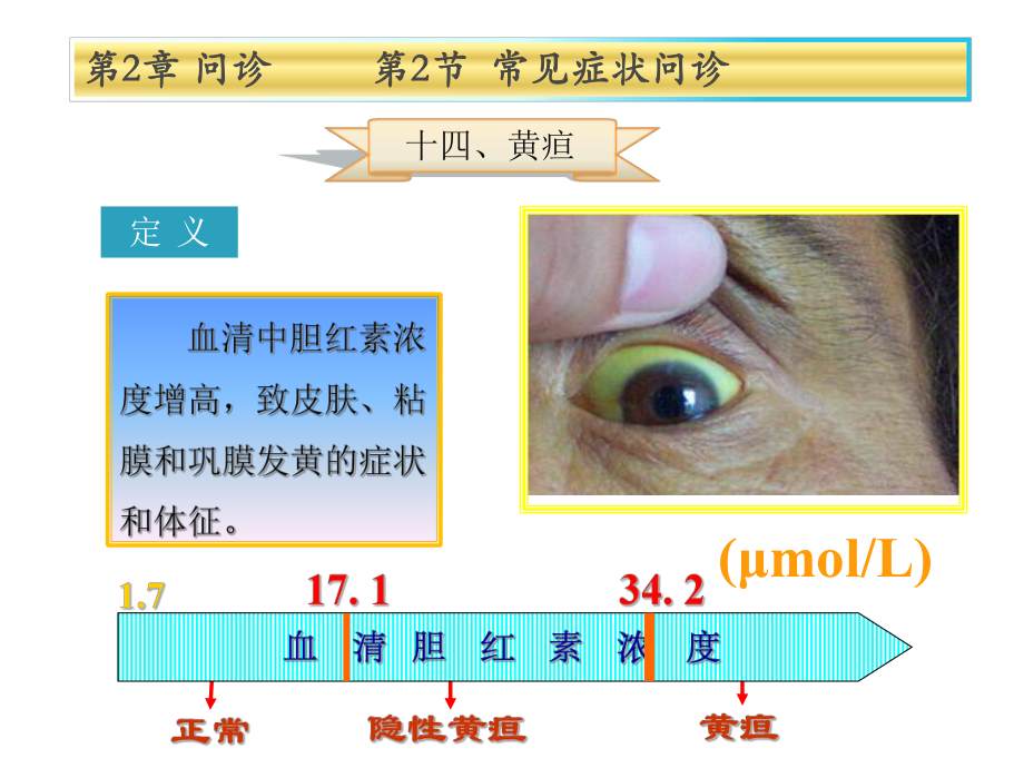 健康评估第2章第2节黄疸ppt课件.ppt_第2页