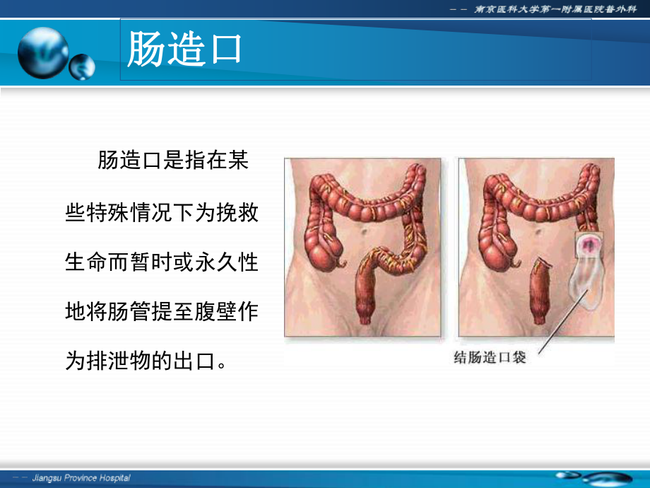 肠造口术前定位ppt课件.ppt_第2页