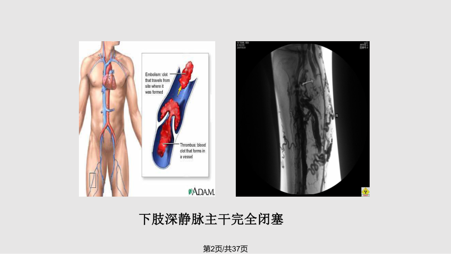 下肢深静脉血栓的护理..pptx_第2页