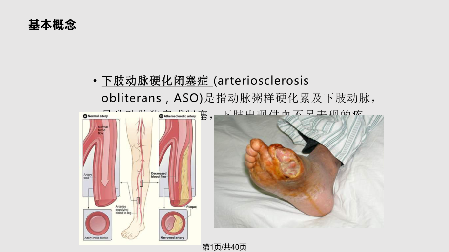 下肢动脉硬化闭塞的临床特点及治疗.pptx_第1页