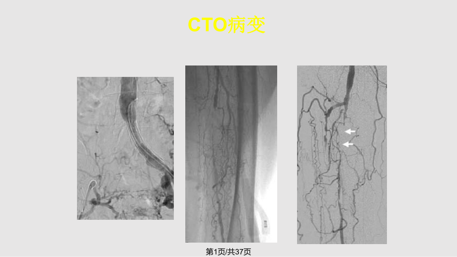 下肢CTO病变介入治疗的新器械和新技术.pptx_第1页