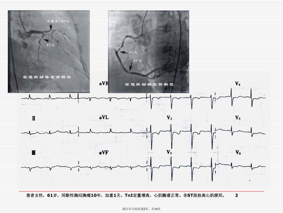 冠状动脉造影与心电图.ppt_第2页