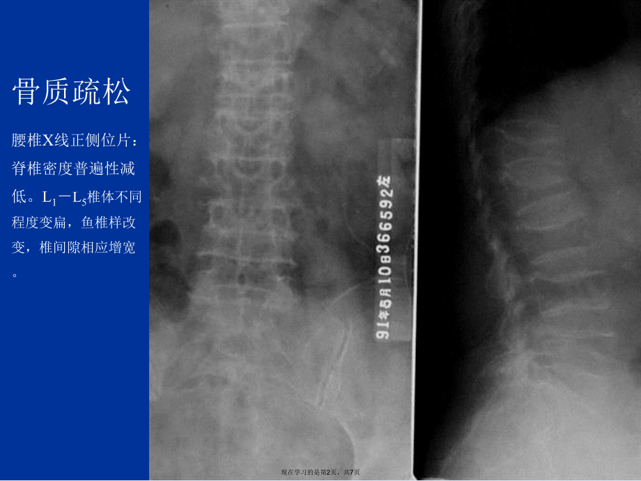 代谢性骨病2.ppt_第2页