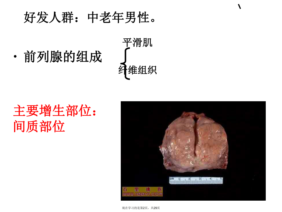 前列腺增生的护理.ppt_第2页