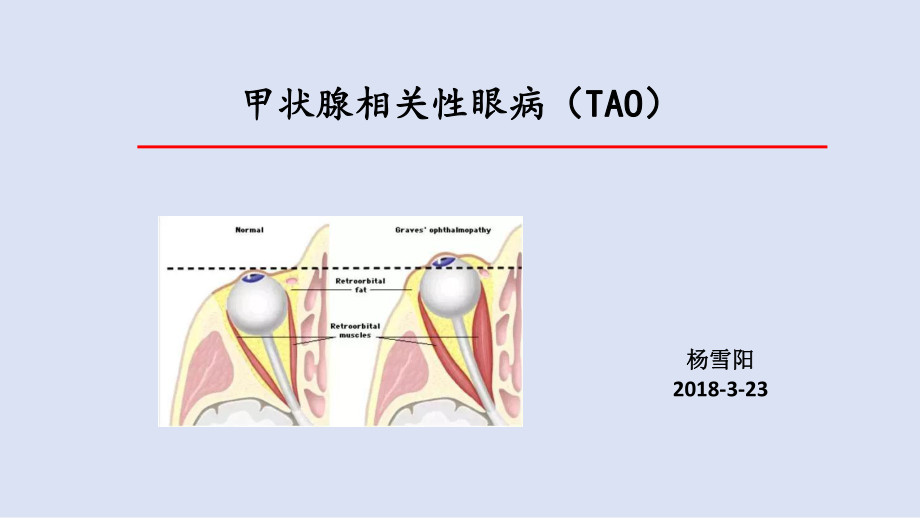 甲状腺相关性眼病ppt课件.pptx_第1页