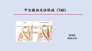 甲状腺相关性眼病ppt课件.pptx