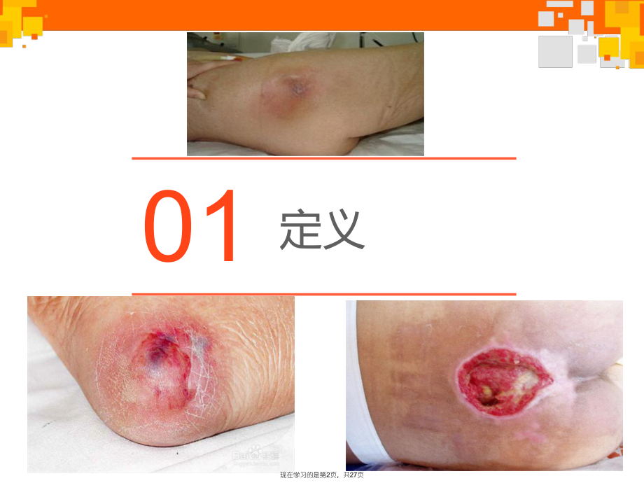 压疮的预防和护理健康宣教.ppt_第2页