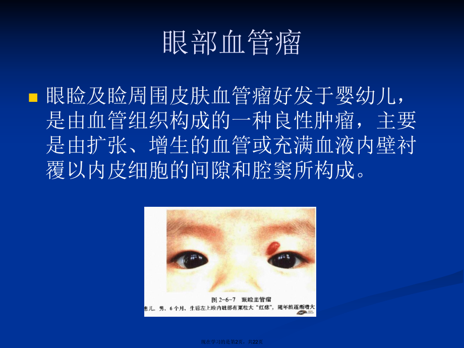 儿童常见眼部肿瘤课件.ppt_第2页