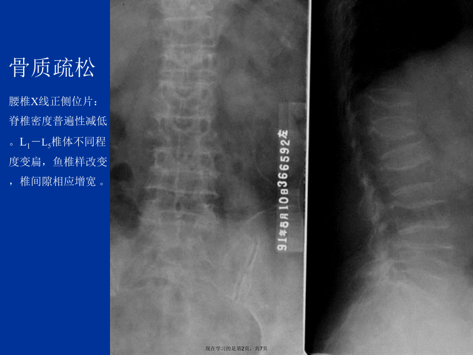 代谢性骨病2课件.ppt_第2页