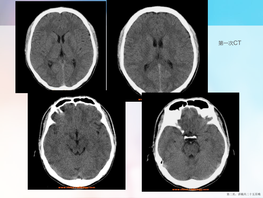 一氧化碳中毒临床和影像诊断讲稿.ppt_第2页