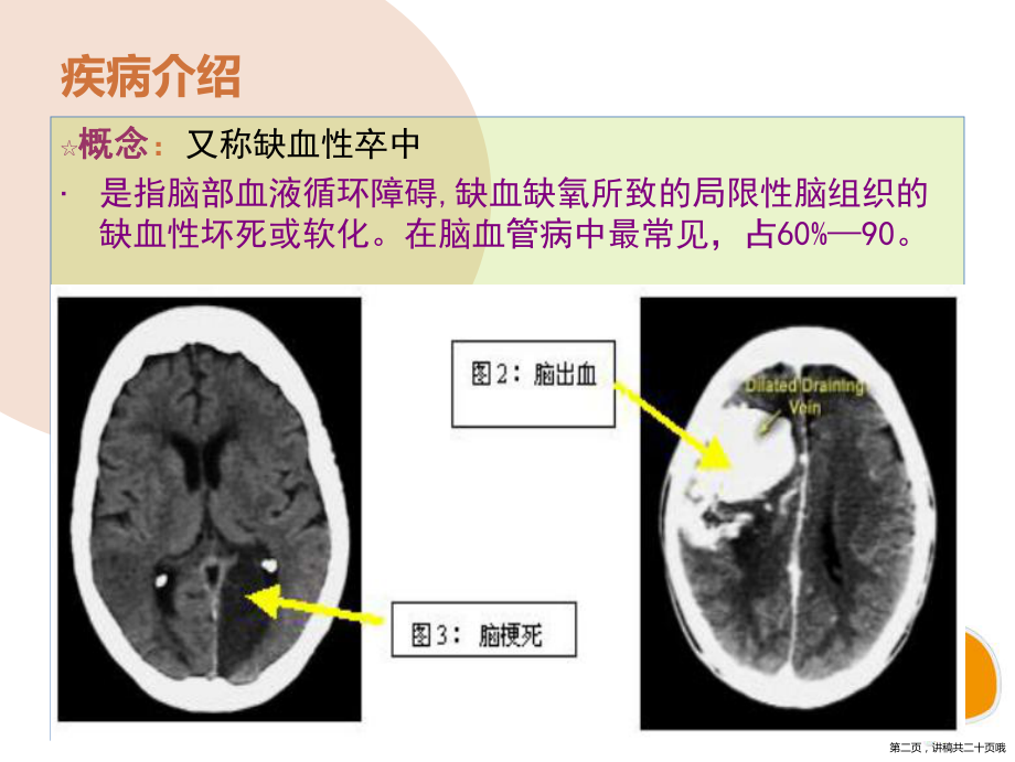 一例脑梗死的护理查房讲稿.ppt_第2页