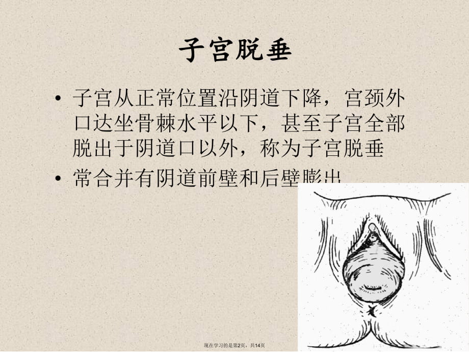 子宫脱垂病人的护理 (2).ppt_第2页