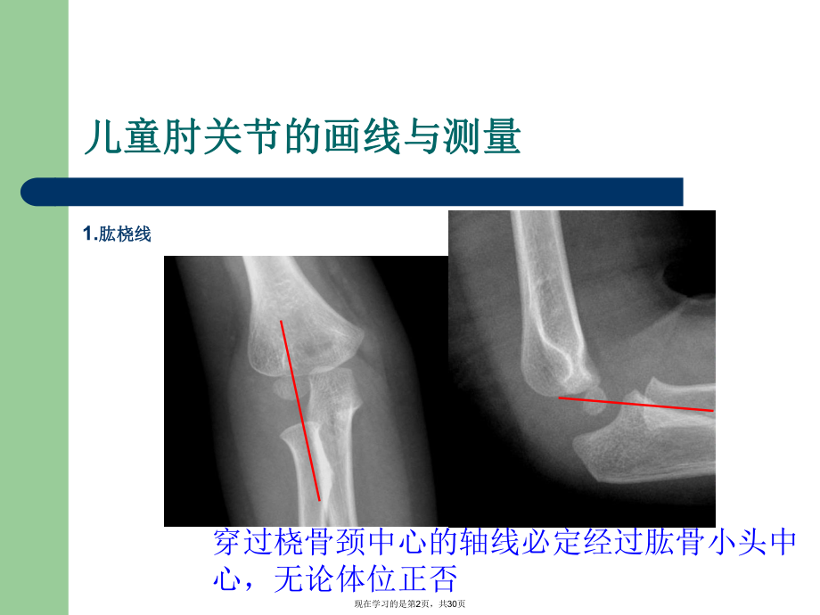 儿童肘关节损伤线诊断课件.ppt_第2页