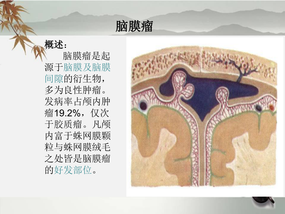 脑膜瘤护理查房ppt课件.ppt_第2页