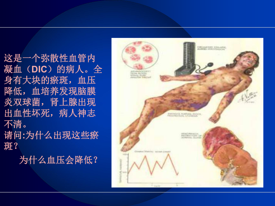 弥漫性血管内凝血ppt课件.ppt_第2页