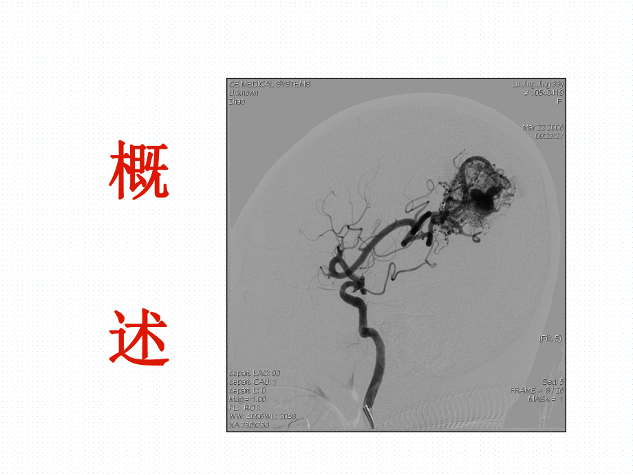 脑动静脉畸形的诊断和治疗ppt课件.pptx_第2页