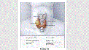 甲状腺髓样癌的治疗和护理.pptx