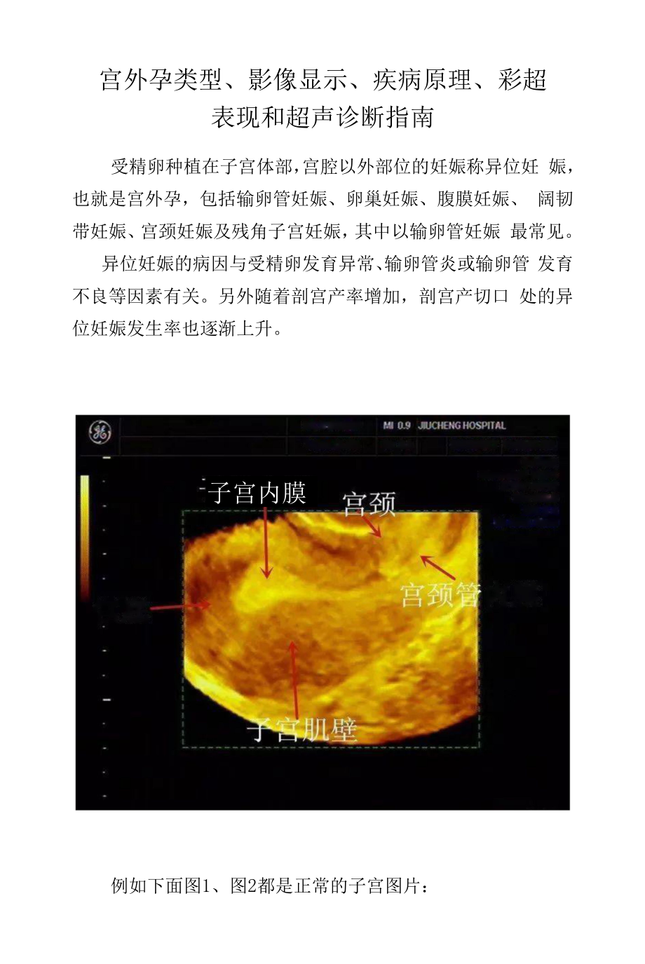 宫外孕类型、影像显示、疾病原理、 彩超表现和超声诊断指南.docx_第1页