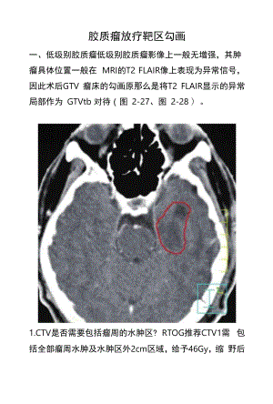 胶质瘤放疗靶区勾画.docx