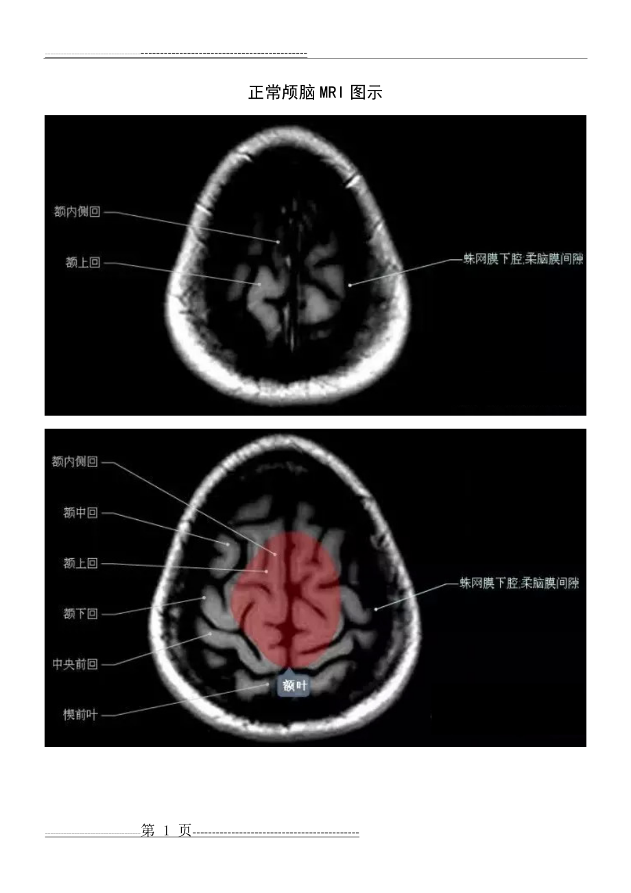 正常颅脑磁共振图示(21页).doc_第1页